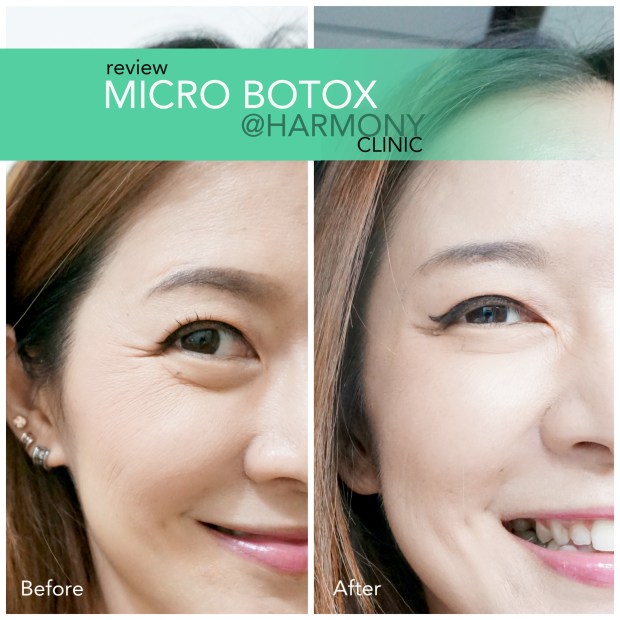 botox,before and after