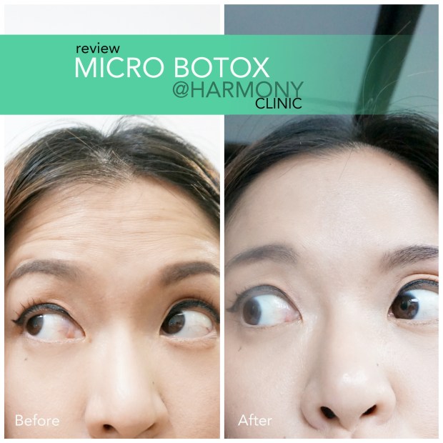 botox,before and after